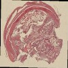 19 LN from bladder GA17.jp2.tif thumbnail