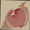 40 lung lesion GA17.jp2.tif thumbnail