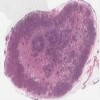 Michigan 142_HISTO_40X.svs.tif thumbnail